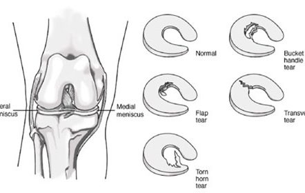 knee-img2 knee-img2