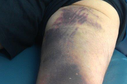 Hamstring-strain1 Hamstring-strain1