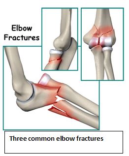 elbow-facture