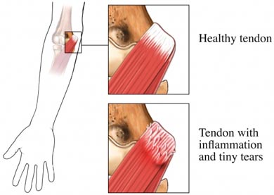 golfers-elbow