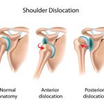 Understanding Shoulder Dislocations