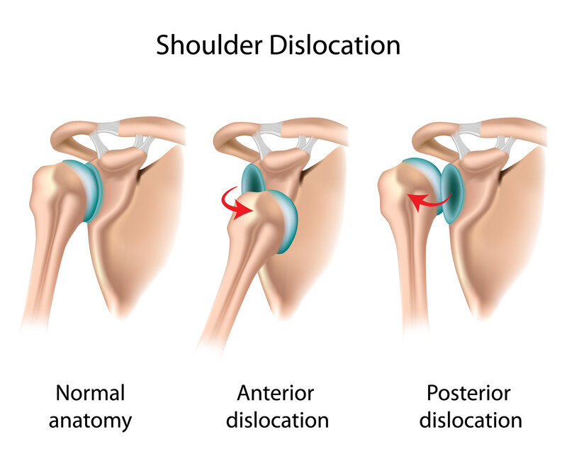 Understanding Shoulder Dislocations