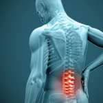 Lumbar Spine Bone Stress Reactions in Young Athletes: What You Need to Know