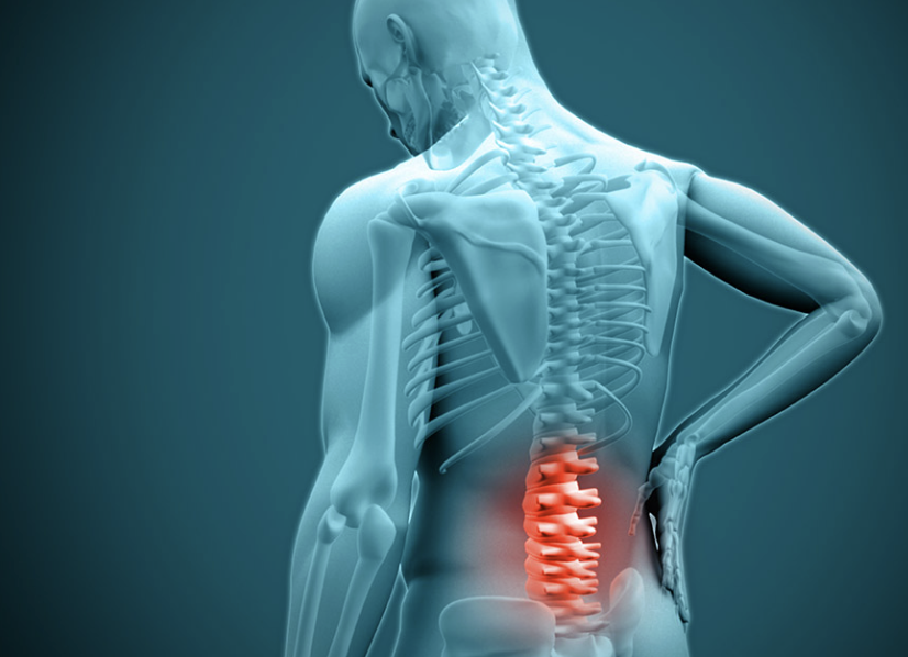 Lumbar Spine Bone Stress Reactions in Young Athletes: What You Need to Know
