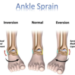 Help! I’ve Rolled My Ankle! What Next?