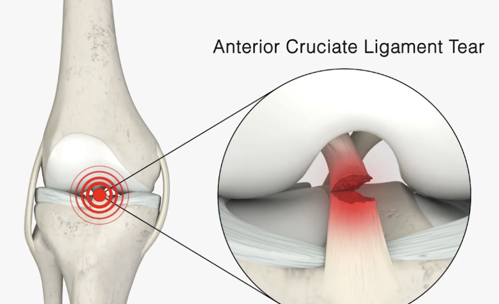 Understanding ACL Injuries: Anatomy, Surgery, and Recovery