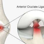 Understanding ACL Injuries: Anatomy, Surgery, and Recovery